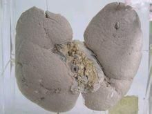 腎功能異常 腎功能異常