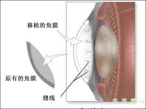 角膜移植術 角膜移植術