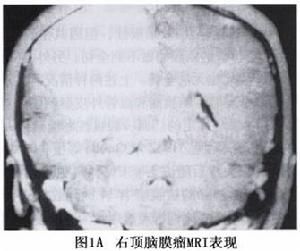 大腦凸面腦膜瘤 大腦凸面腦膜瘤