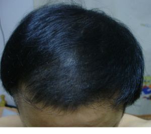 男性脫髮 男性脫髮