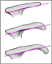 （圖）撞擊征的示意圖