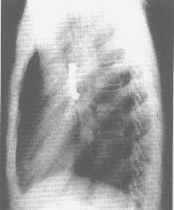 氣管、支氣管異物