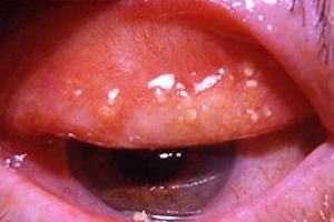 眼瞼結石 眼瞼結石