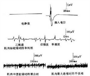 酒精中毒性肌病