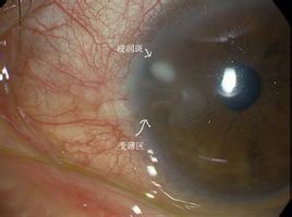 病毒性角膜炎 病毒性角膜炎