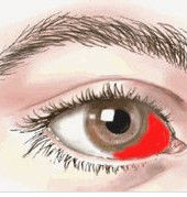 球結膜下出血 球結膜下出血