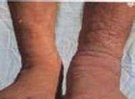 脛前和足部堅硬的非凹陷性水腫斑塊 脛前和足部堅硬的非凹陷性水腫斑塊