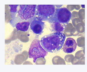 淋巴細胞減少症