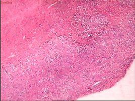 股骨下端腫瘤切除術 股骨下端腫瘤切除術
