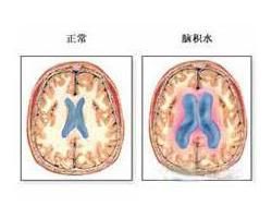 腦積水 腦積水