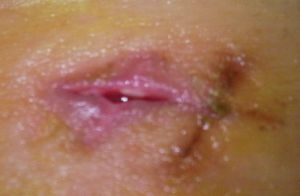 傷口感染 傷口感染