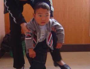 小兒錐體功能不良綜合徵 小兒錐體功能不良綜合徵