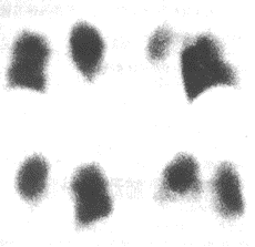 妊娠合併肺栓塞