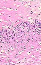 假性尖銳濕疣 假性尖銳濕疣