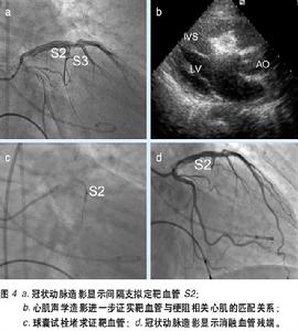 肥厚型梗阻性心肌病 肥厚型梗阻性心肌病
