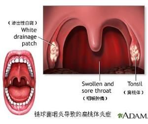 咽喉炎
