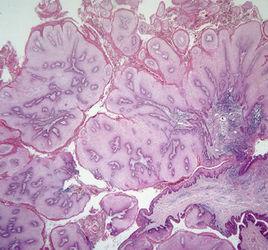 肛周囊腫 肛周囊腫