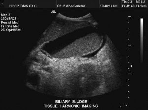 膽汁淤積 膽汁淤積