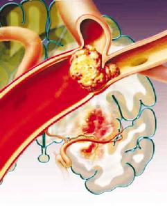 老年人急性心肌梗死