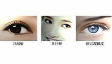 上瞼下垂矯正術效果圖