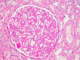 難治性腎病綜合徵 難治性腎病綜合徵