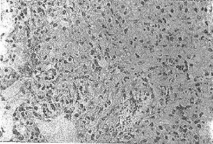 對氨基水楊酸鈉