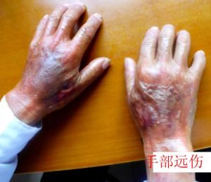 遠傷 遠傷