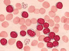 （圖）慢性淋巴細胞白血病血象