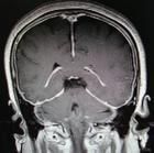 低顱壓綜合症 低顱壓綜合症