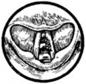 喉裂開術 喉裂開術