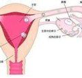 宮頸妊娠