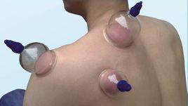 針灸拔火罐 針灸拔火罐