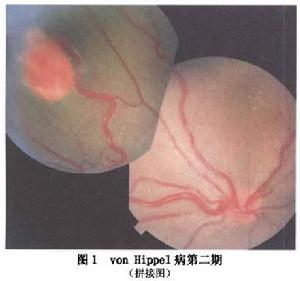 視網膜毛細血管血管瘤