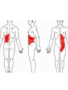 肋骨神經痛 肋骨神經痛