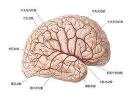 多小腦回畸形 多小腦回畸形