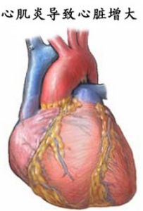 心肌炎後遺症 心肌炎後遺症