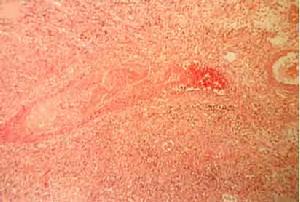 肺良性淋巴細胞血管炎和肉芽腫病