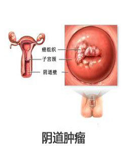 陰道癌 陰道癌