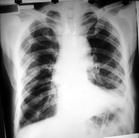 社會獲得性肺炎