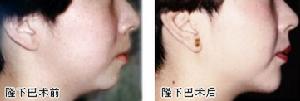 頦部整形美容術