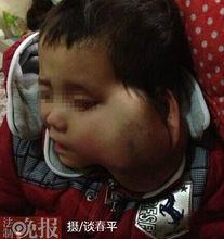 趙子涵[因患眼癌而受關注的話題人物]