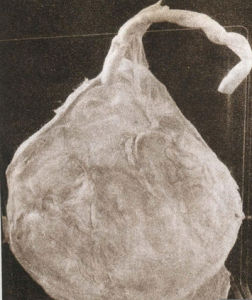 球拍狀胎盤 球拍狀胎盤