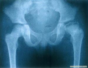 （圖）成人骨壞死