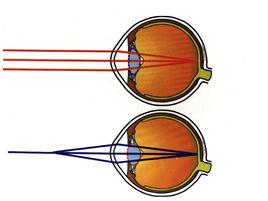 晶狀體突出 晶狀體突出