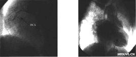 左心室造影 左心室造影