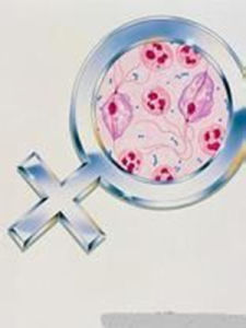 念珠菌性陰道炎 念珠菌性陰道炎