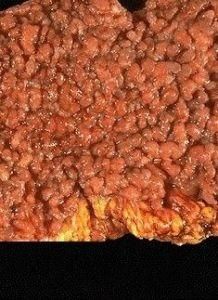 表皮囊腫 表皮囊腫