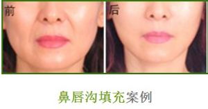 鼻唇溝填充案例