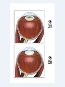 青光眼雷射手術 青光眼雷射手術