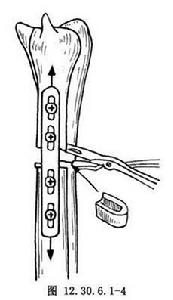 尺骨遠端延長術 尺骨遠端延長術